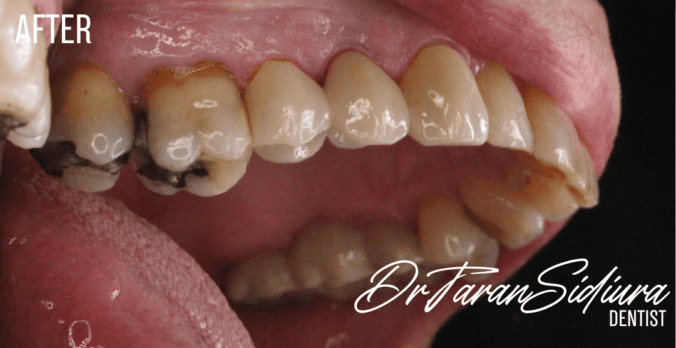 Tooth Removal After