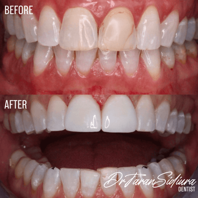 Restorative Dentistry Before and After Oakville Burlington 