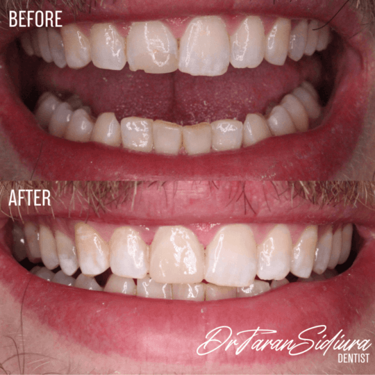 Restorative Dentistry Before and After Oakville Burlington 