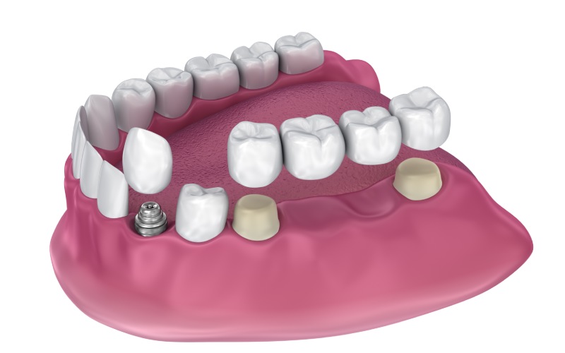 tooth supported fixed bridge implant crown medically accurate illustration