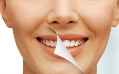 Teeth Whitening FAQs: Your Questions Answered