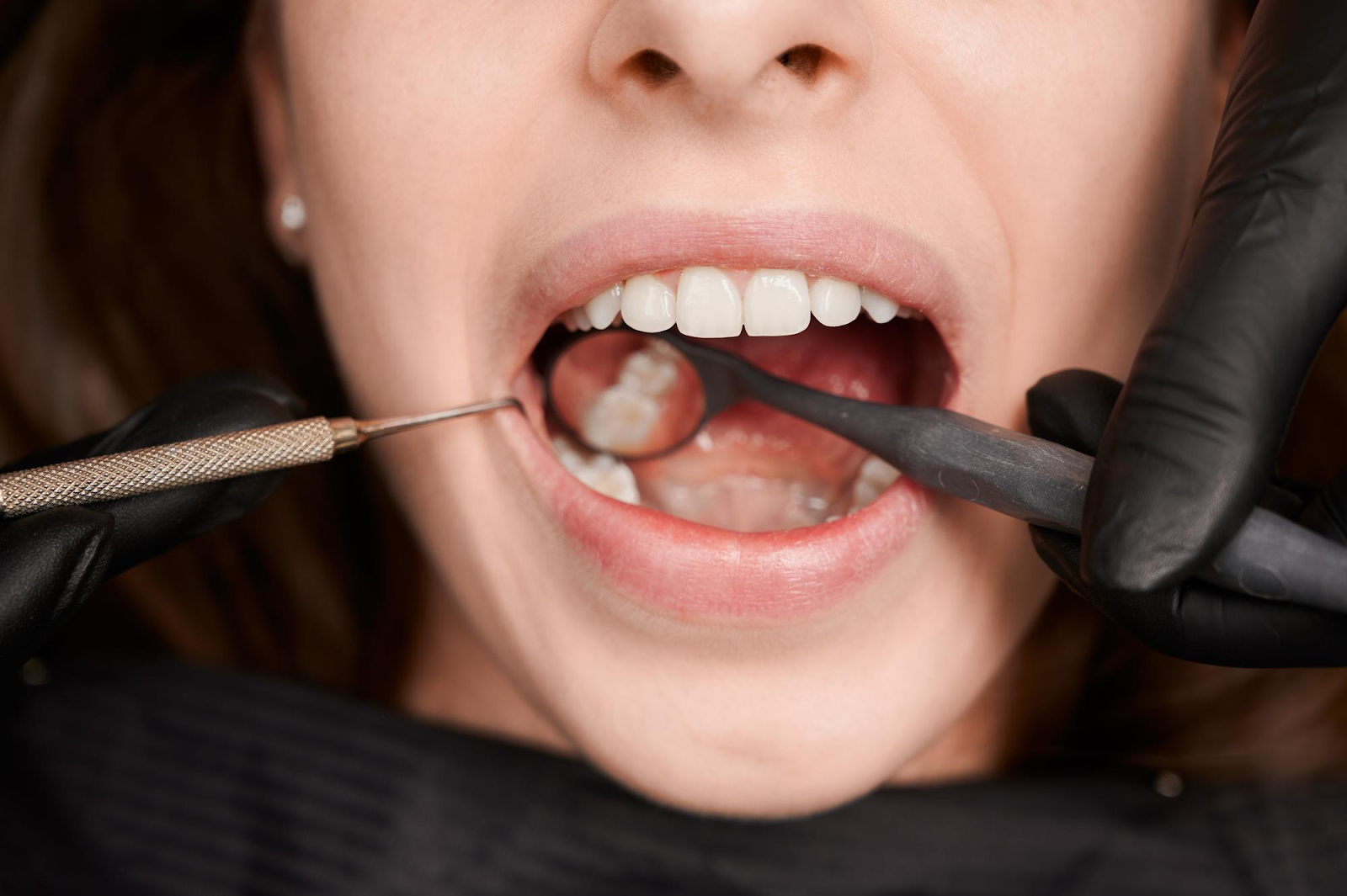 The Procedure for Cosmetic Crowns
